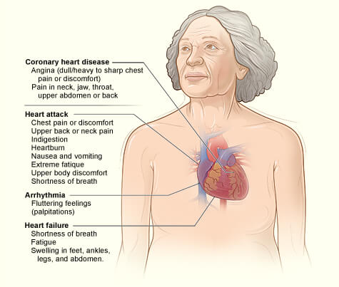 angina-pectoris